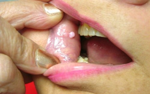 White Pimple Inside Mouth