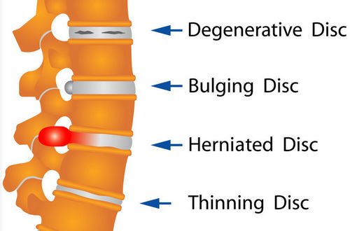 A degenerative disc compared with other disc-related conditions image photo picture