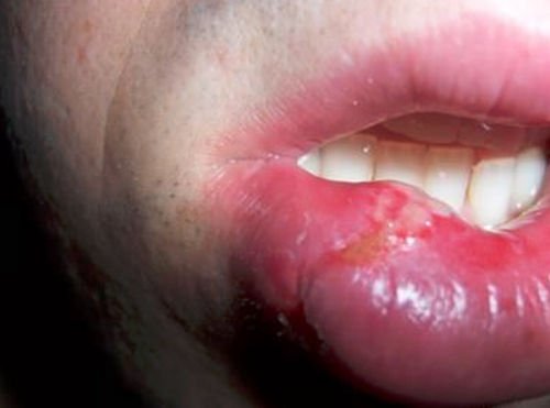 A severely swollen lip due to excessive biting image photo picture