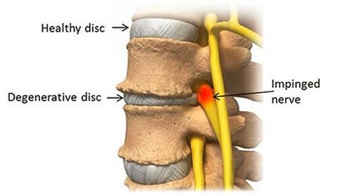 An image outlining the difference between a healthy disc and a degenerative disc picture photo