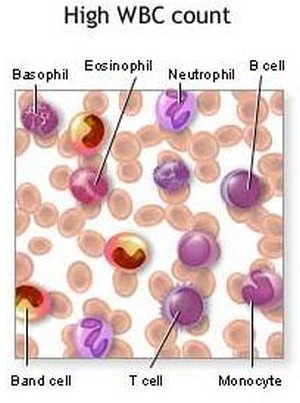 Leukocytosis - High wbc count
