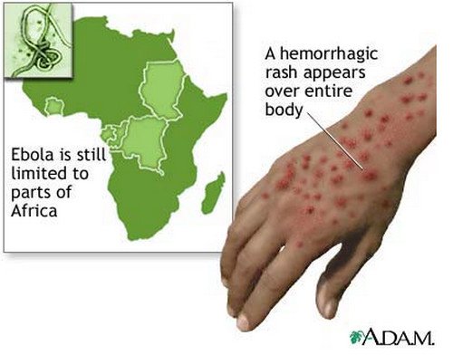 Ebola Hemorrhagic Fever rash on hand