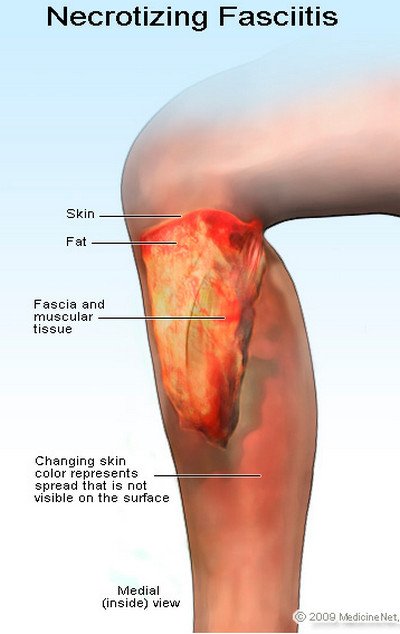 Necrotizing Fasciitis symptoms