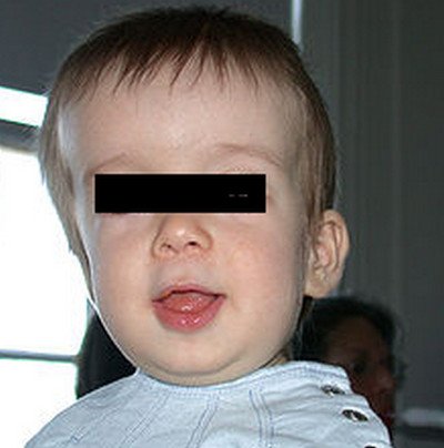 craniosynostosis of the lambdoid suture