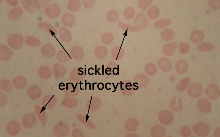 sicke cell anemia histology