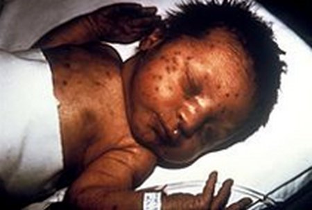 A child with rashes from congenital rubella