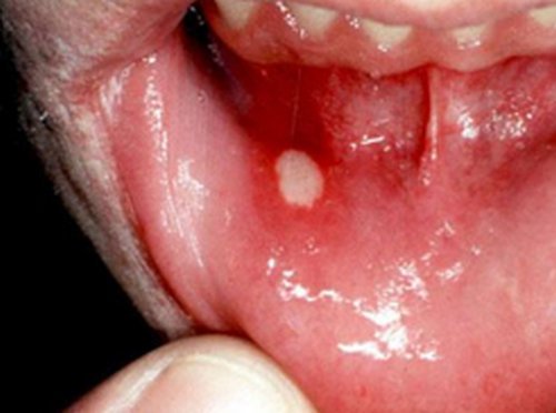 Canker sores inside lower lip