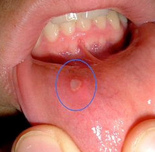 Canker sores