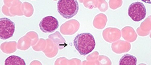 Immature granulocytes - Causes, Absolute and Normal range