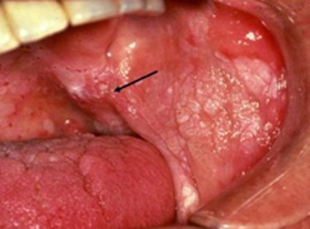 Erythroleukoplakia