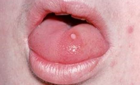 Lip warts caused by HPV