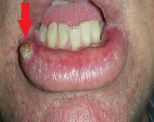 Lower lip cancerous white bump