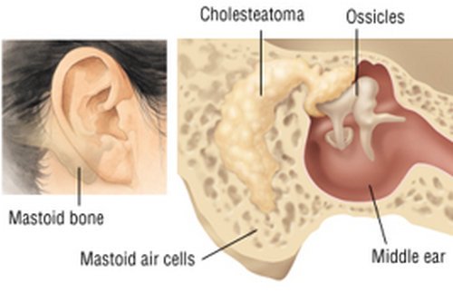 Mastoid bone