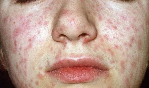 rash that moves to different parts of the body