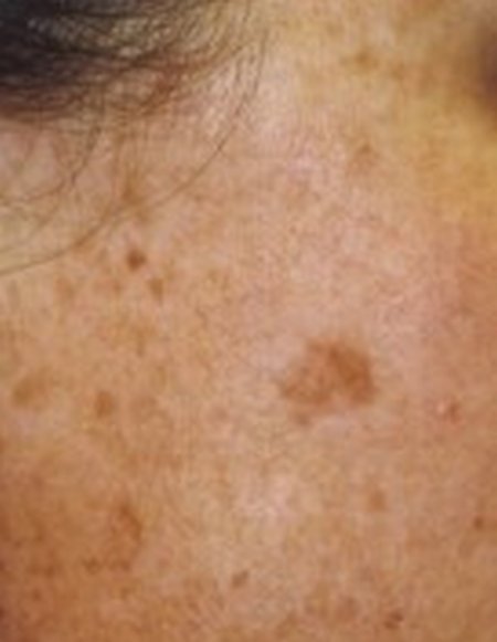 Download Sunspots on skin - What are they and how to get rid of ...