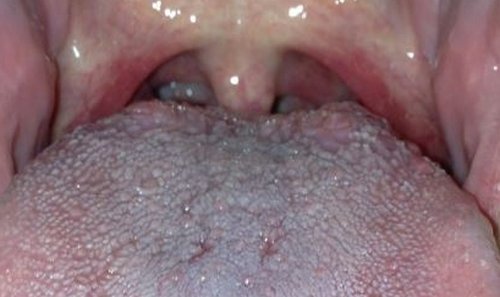 How to get rid of swollen taste buds on tongue