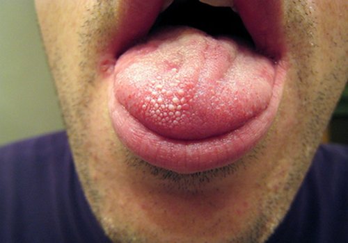 Wart on tongue