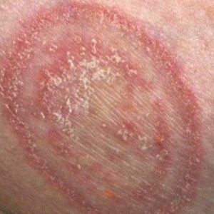 Underarm Rash (Itchy, Painful) - Pictures, Causes, Treatment