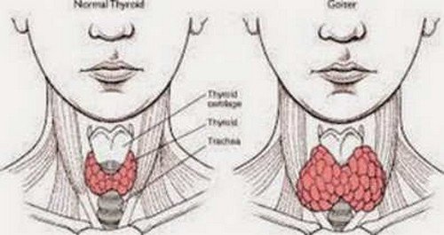 A comparison image between a healthy-normal thyroid and a swollen thyroid thyromegaly image photo pictures