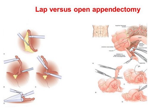 A comparison image between minimally invasive removal of the appendix and open appendectomy location photo picture