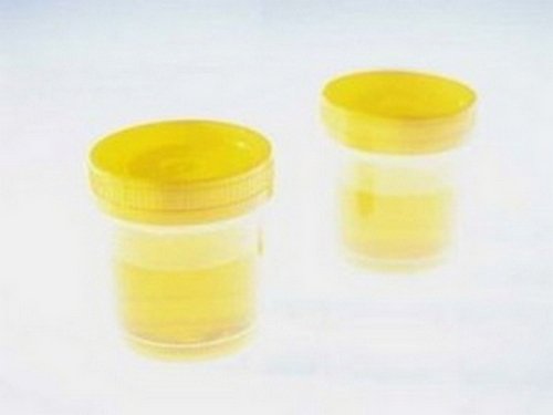 A urine sample of a child with a large number of mucus Mucus in urine image photo picture