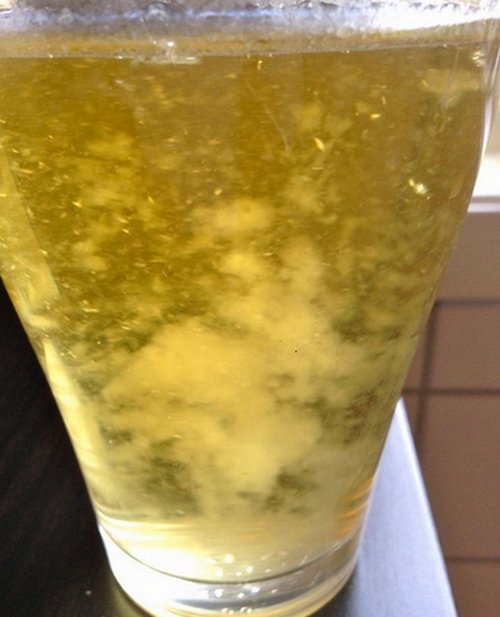 A urine sample of a patient that appears cloudy, which is indicative of excess amount of mucus image picture photo