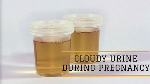 A urine sample of a pregnant woman Mucus in urine image photo picture
