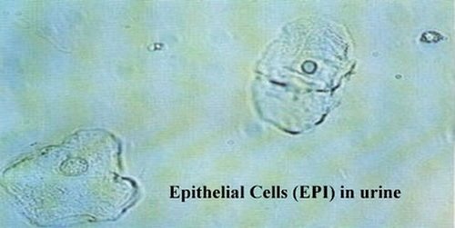 A urine sample showing epithelial cells Mucus in urine image photo picture