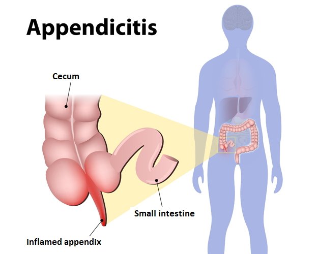 An image showing an inflamed appendix (appendicitis) location photo picture