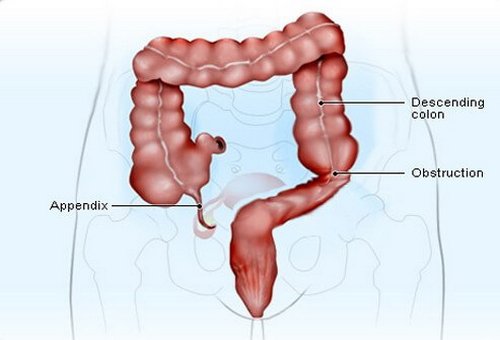 What side is your appendix on?