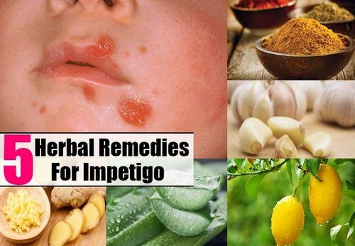 Plants and herbs extracts are helpful in the treatment and management of impetigo and other types of infections image picture photo