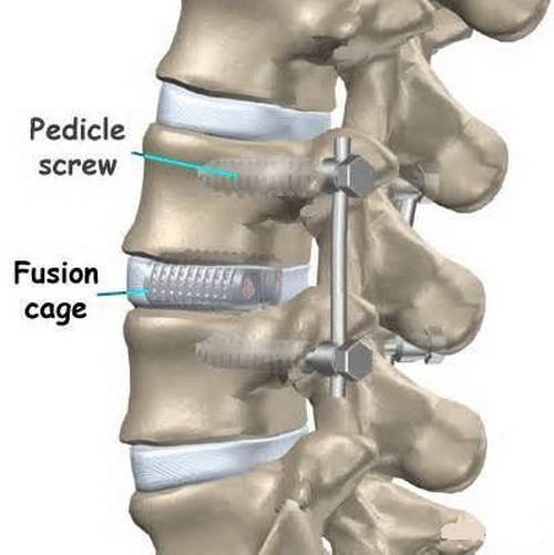 A closer look at a disc that underwent a spinal fusion surgery image photo picture