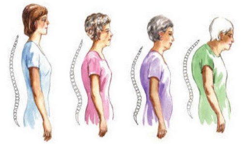 How the shape of the spine changes with age image photo picture