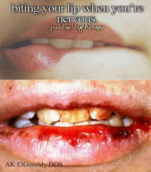 Swelling and bleeding of the lips secondary to severe and chronic biting im...