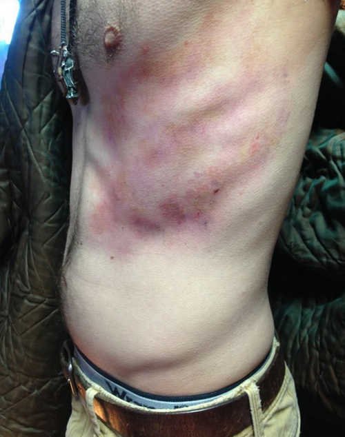 A severe bruising of the ribs image photo picture