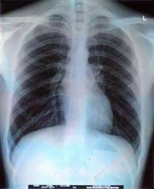 An imaging study of the chest wherein there is an obvious rib bruising secondary to excessive coughing image photo picture