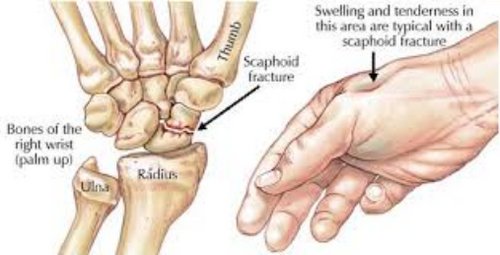 Swelling and tenderness are the cardinal signs of anatomical snuff box fracture image photo picture