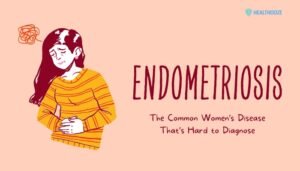 Endometriosis- The Common Women’s Disease That’s Hard to Diagnose