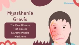 Myasthenia Gravis- The Rare Disease That Causes Extreme Muscle Weakness