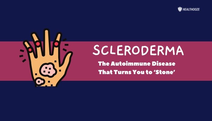 Scleroderma- The Autoimmune Disease That Turns You to ‘Stone’
